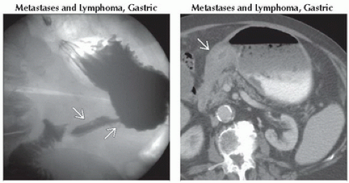 Lenitis DA4-DB1-Linitis_Plastica_Limited_Distensibility-FFU4.gif | Abdominal Key