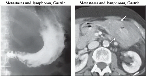 Lenitis DA4-DB1-Linitis_Plastica_Limited_Distensibility-FFU5.gif | Abdominal Key