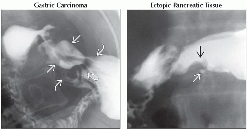 DA4-DB1-Target_or_Bulls_Eye_Lesions_Stomach-FFU4.gif | Abdominal Key