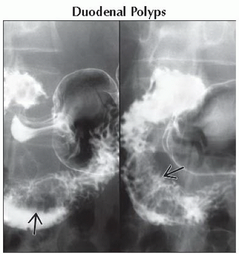 Da5 Db1 Duodenalfillingdefects Ffu2 Abdominal Key