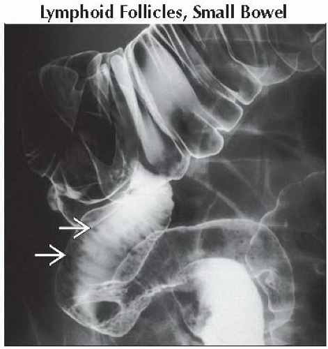DA6-DB1-Multiple_Masses_or_Filling_Defects_Small_Bowel-FFU1.gif ...