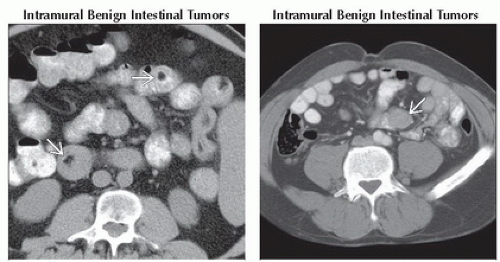 DA6-DB1-Multiple_Masses_or_Filling_Defects_Small_Bowel-FFU4.gif ...