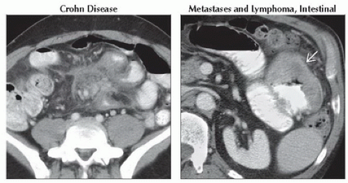 DA6-DB2-Occult_GI_Bleeding-FFU3.gif | Abdominal Key