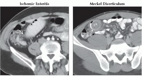 DA6-DB2-Small_Bowel_Obstruction-FFU14.gif | Abdominal Key