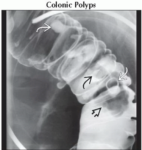 DA7-DB1-Multiple_Colonic_Filling_Defects-FFU2.gif | Abdominal Key