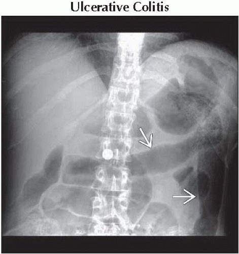 DA7-DB1-Smooth_Ahaustral_Colon-FFU1.gif | Abdominal Key