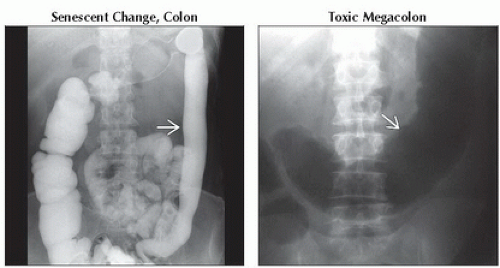 DA7-DB1-Smooth_Ahaustral_Colon-FFU4.gif | Abdominal Key