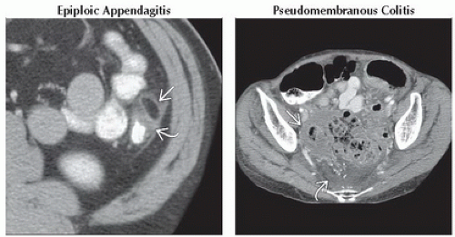 DA7-DB2-Acute_Left_Lower_Quadrant_Pain-FFU4.gif | Abdominal Key