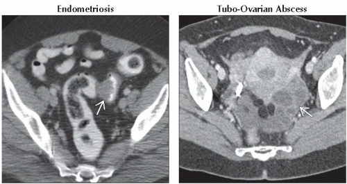 DA7-DB2-Acute_Left_Lower_Quadrant_Pain-FFU7.gif | Abdominal Key