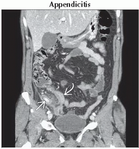 da7-db2-acute-right-lower-quadrant-pain-ffu2-gif-abdominal-key