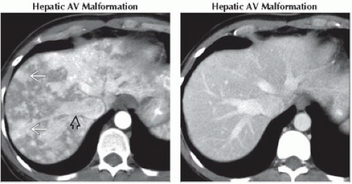 DA9-DB1-Focal_Hyperperfusion_Abnormality_THAD_or_THID-FFU11.gif ...