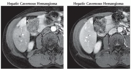 DA9-DB1-Focal_Hyperperfusion_Abnormality_THAD_or_THID-FFU9.gif ...