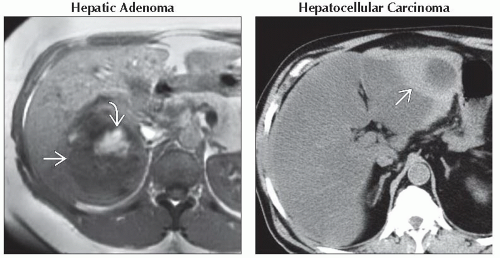 DA9-DB1-Focal_Liver_Lesion_with_Hemorrhage-FFU3.gif | Abdominal Key