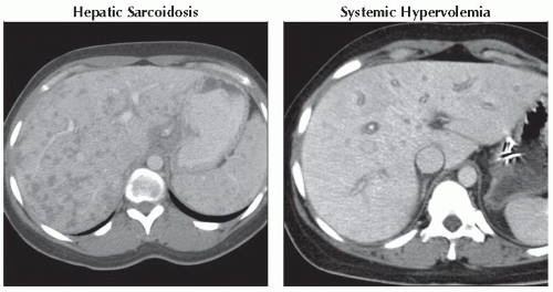 DA9-DB1-Mosaic_or_Patchy_Hepatogram-FFU5.gif | Abdominal Key