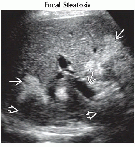 DA9-DB2-Focal_Hepatic_Echogenic_Lesion_Acoustic_Shadowing-FFU1.gif ...