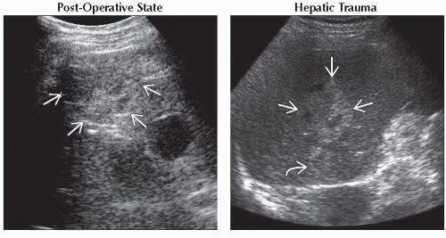 DA9-DB2-Focal_Hepatic_Echogenic_Lesion_Acoustic_Shadowing-FFU14.gif ...