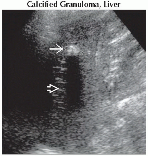 DA9-DB2-Focal_Hepatic_Echogenic_Lesion_Acoustic_Shadowing-FFU2.gif ...