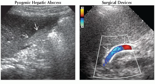 DA9-DB2-Focal_Hepatic_Echogenic_Lesion_Acoustic_Shadowing-FFU6.gif ...