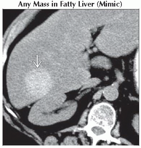 DA9-DB2-Focal_Hyperdense_Hepatic_Mass_on_Nonenhanced_CT-FFU2.gif ...