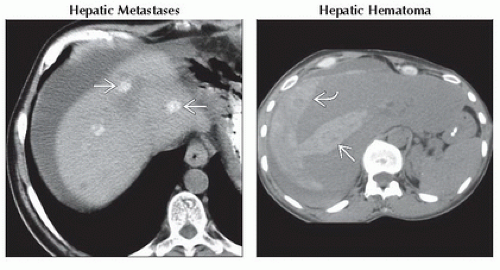 DA9-DB2-Focal_Hyperdense_Hepatic_Mass_on_Nonenhanced_CT-FFU4.gif ...