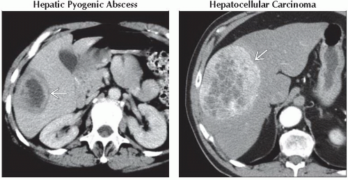 DA9-DB2-Liver_Lesion_with_Capsule_or_Halo_on_MR-FFU3.gif | Abdominal Key