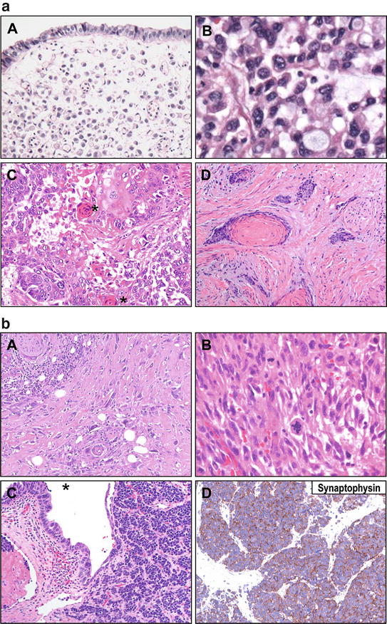 Upper Urinary Tract Urothelial Carcinoma Pathology | Abdominal Key