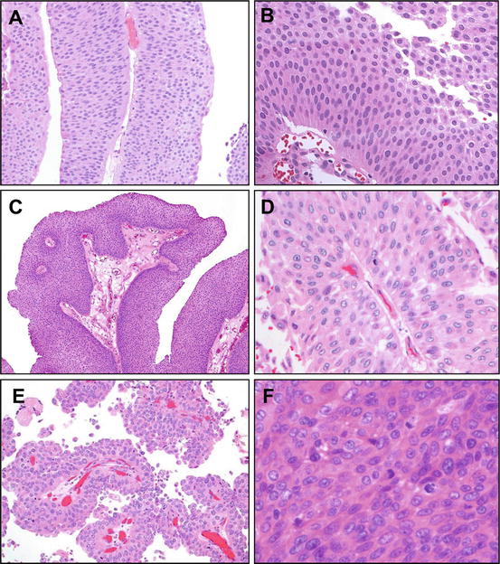 Upper Urinary Tract Urothelial Carcinoma Pathology | Abdominal Key