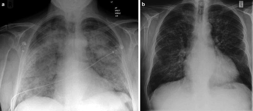 Anti-glomerular Basement Membrane Disease | Abdominal Key