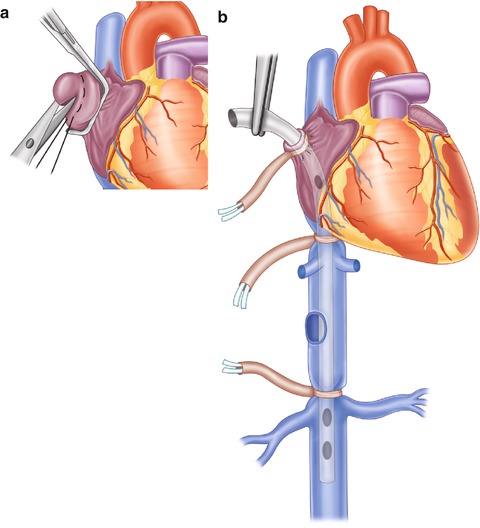 Juxtahepatic Venous Injuries | Abdominal Key