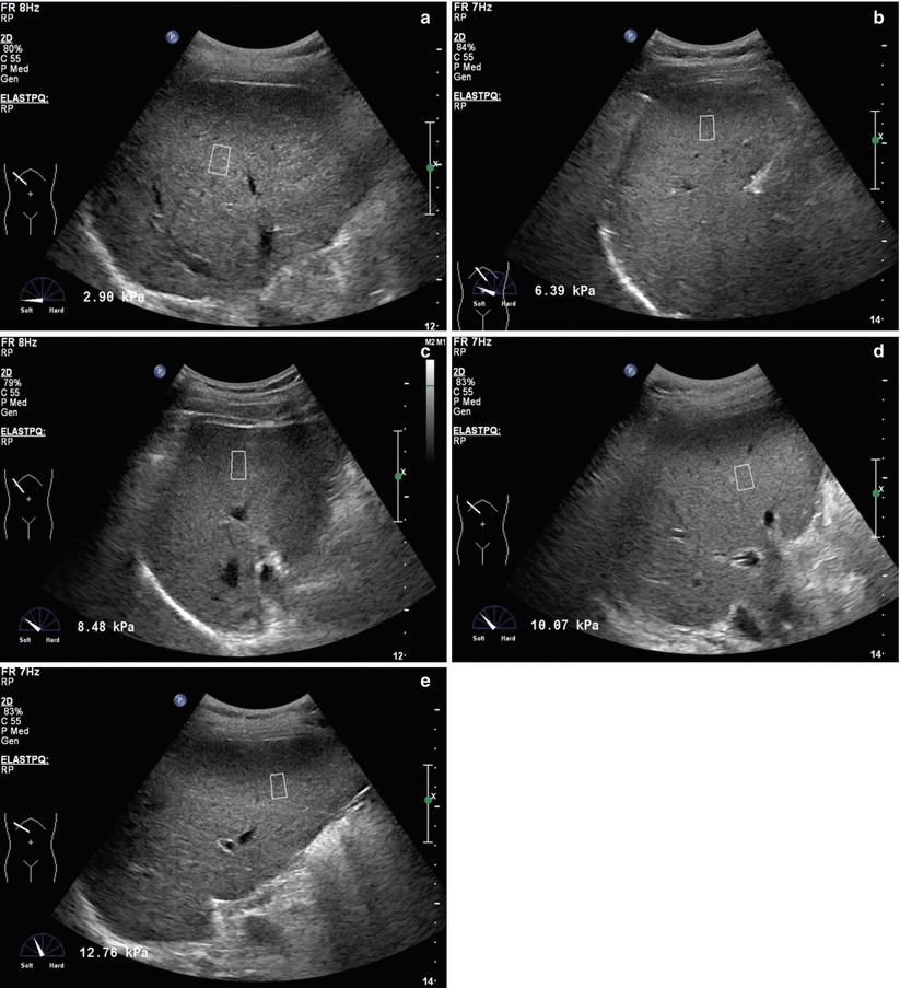 Ultrasound Elastography In The Assessment Of Liver Fibrosis Abdominal Key