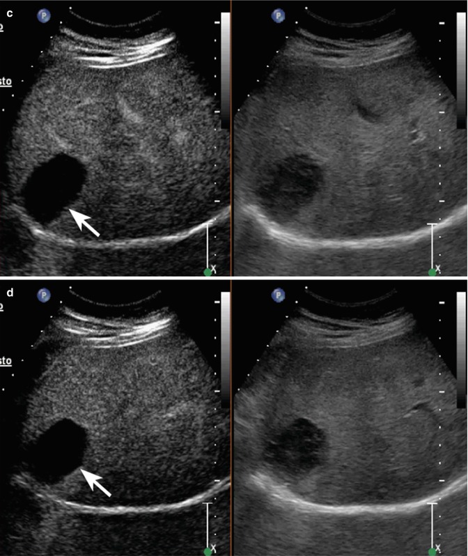 benign-focal-liver-lesions-abdominal-key