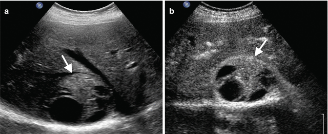 Other Rare Lesions | Abdominal Key