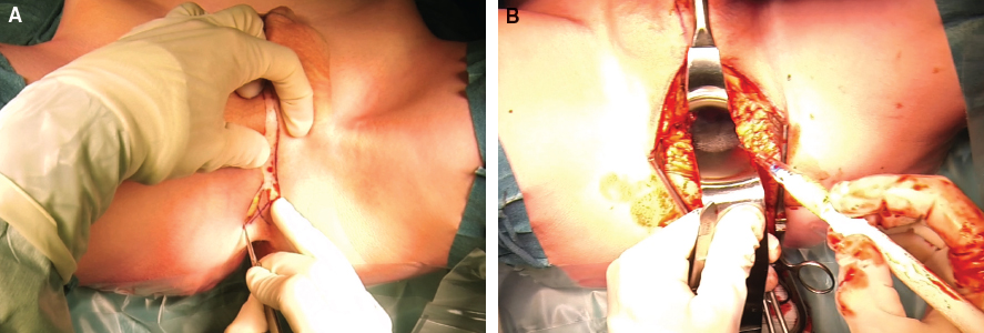 6-1 Surgical construction of the female external genitalia. 