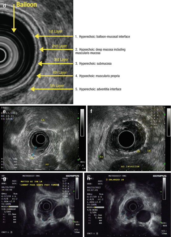 Mapping Esophageal Disease with Endoscopic Ultrasound | Abdominal Key