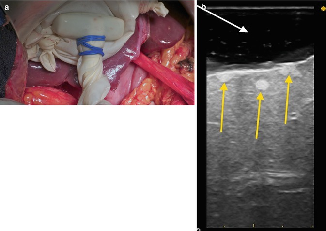 Intraoperative And Laparoscopic Ultrasound During Liver Surgery Abdominal Key