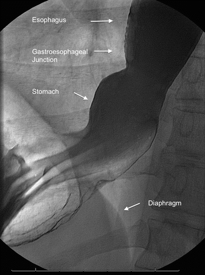 Approaches to the diagnosis and grading of hiatal hernia - ScienceDirect