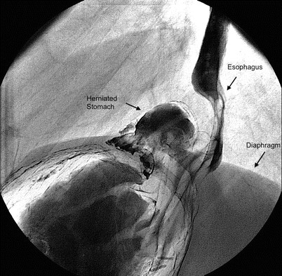 Schatzki ring of oesophagus - YouTube