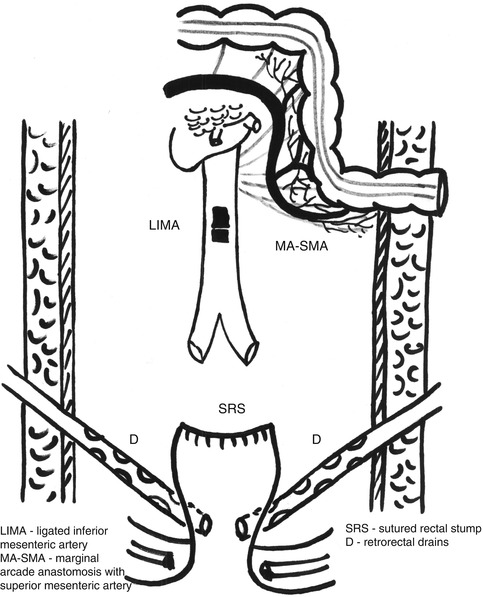 Hartmann’s Resection | Abdominal Key