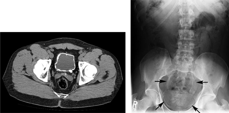 Ureterocele Ivp