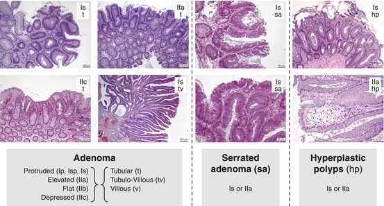 villous adenoma vs tubular adenoma