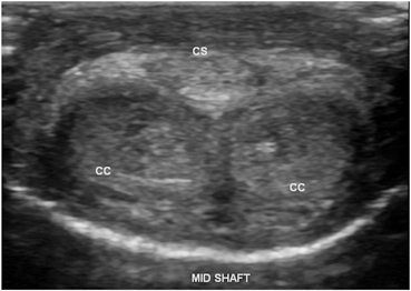 Penile Ultrasound | Abdominal Key