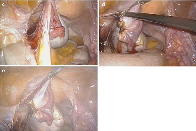 Single-Port Laparoscopic Adnexal Surgery | Abdominal Key