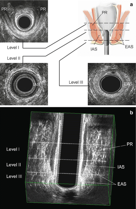 Three Dimensional Endoanal Ultrasonography Of The Anorectal Region Abdominal Key