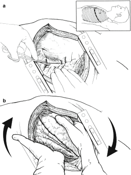 Surgical Treatment Of Thoracic Trauma: Lung | Abdominal Key