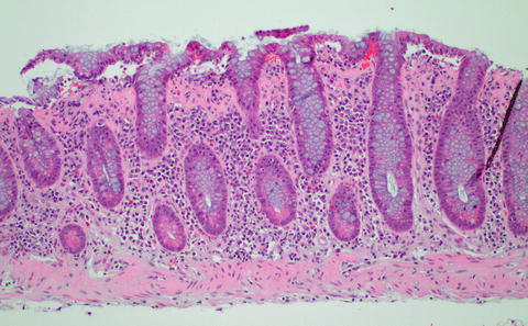 Histopathologic Diagnosis Of Inflammatory Bowel Disease | Abdominal Key