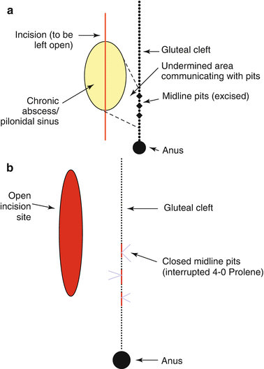 Pilonidal Sinus - Clinical Features - Management - TeachMeSurgery