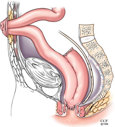 Ileal Pouch Complications