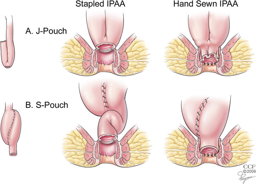 Ileal Pouch Anal Anastomosis (IPAA) Reconstruction after