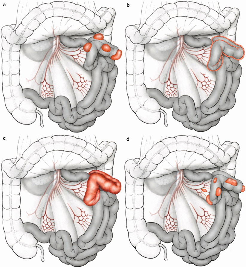 A978-1-4614-9022-7_5_Fig1a_HTML.gif