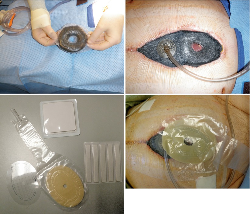 Stoma Fistula Progression Bedeleven